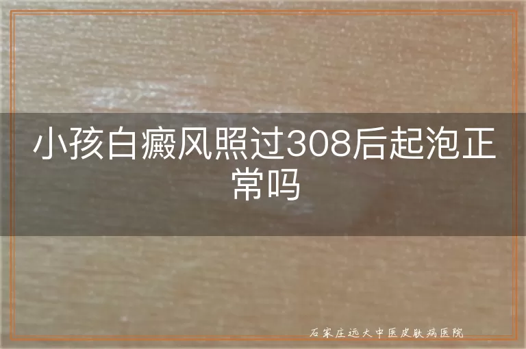 小孩白癜风照过308后起泡正常吗