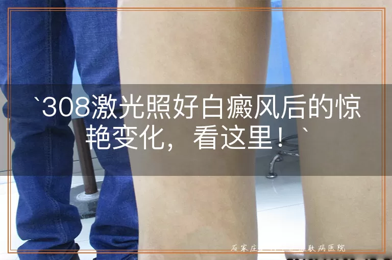 308激光照好白癜风后的惊艳变化，看这里！