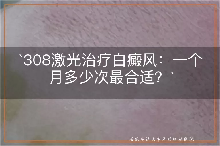 308激光治疗白癜风：一个月多少次最合适？