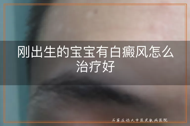 刚出生的宝宝有白癜风怎么治疗好