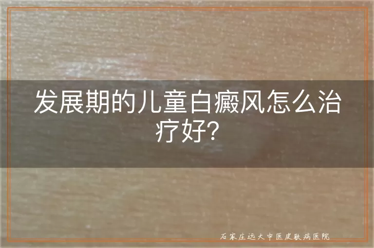 发展期的儿童白癜风怎么治疗好？