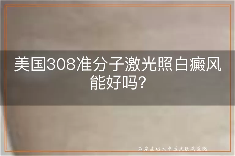 美国308准分子激光照白癜风能好吗？