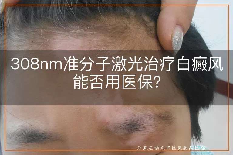 308nm准分子激光治疗白癜风能否用医保？