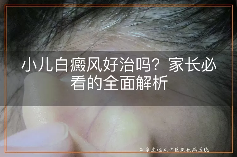 小儿白癜风好治吗？家长必看的全面解析