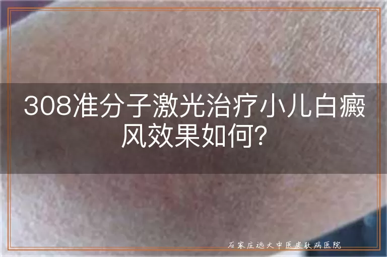 308准分子激光治疗小儿白癜风效果如何？