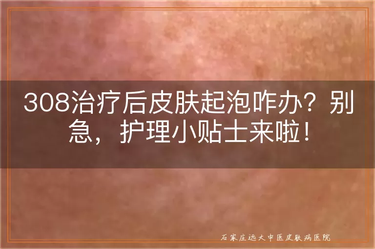 308治疗后皮肤起泡咋办？别急，护理小贴士来啦！