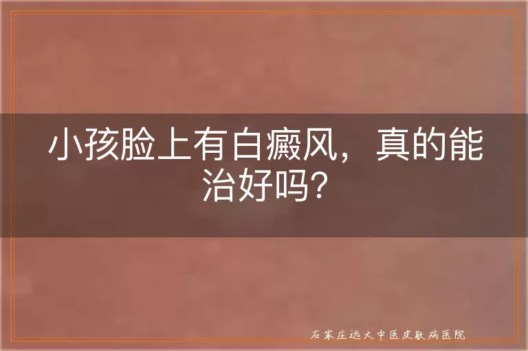 小孩脸上有白癜风，真的能治好吗？