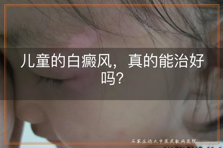 儿童的白癜风，真的能治好吗？