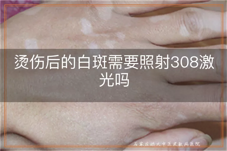 烫伤后的白斑需要照射308激光吗