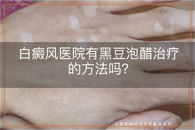 白癜风医院有黑豆泡醋治疗的方法吗？