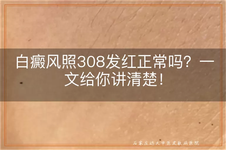 白癜风照308发红正常吗？一文给你讲清楚！