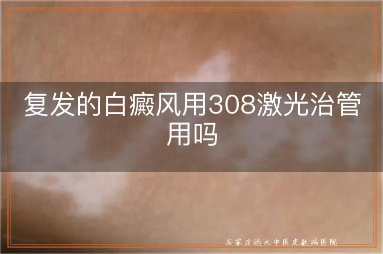 复发的白癜风用308激光治管用吗