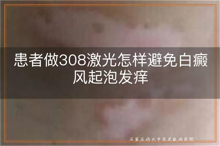 患者做308激光怎样避免白癜风起泡发痒