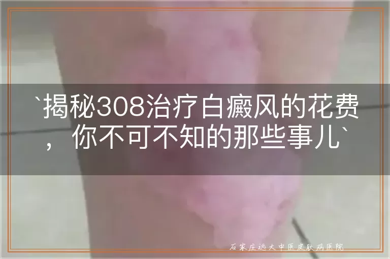 揭秘308治疗白癜风的花费，你不可不知的那些事儿