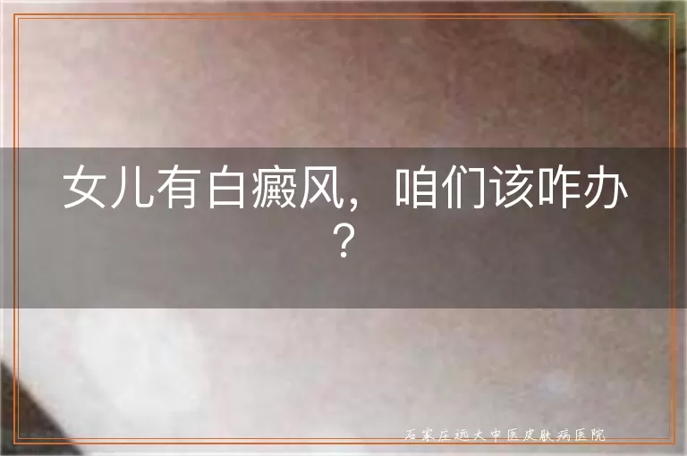 女儿有白癜风，咱们该咋办？