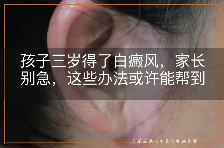 孩子三岁得了白癜风，家长别急，这些办法或许能帮到你