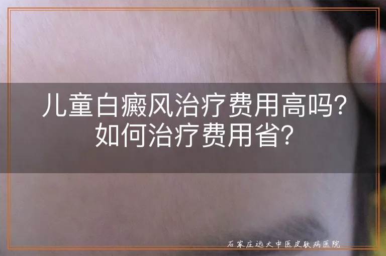儿童白癜风治疗费用高吗?如何治疗费用省?