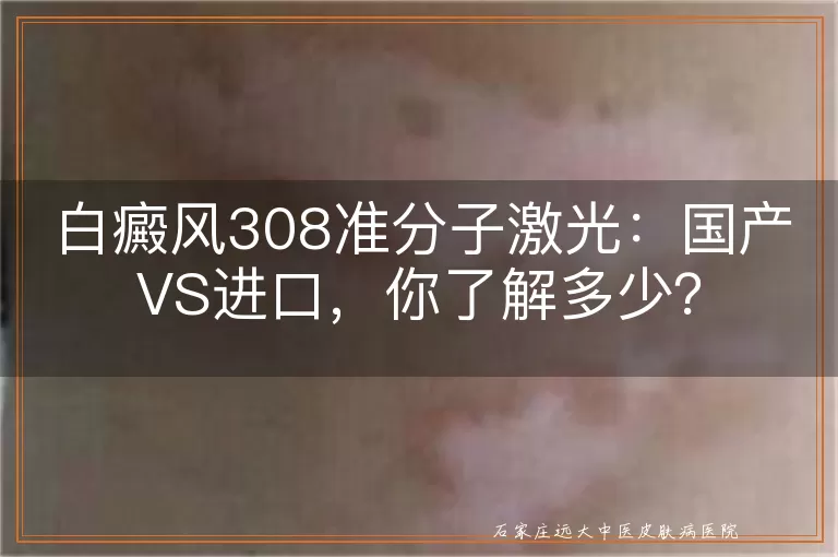 白癜风308准分子激光：国产VS进口，你了解多少？
