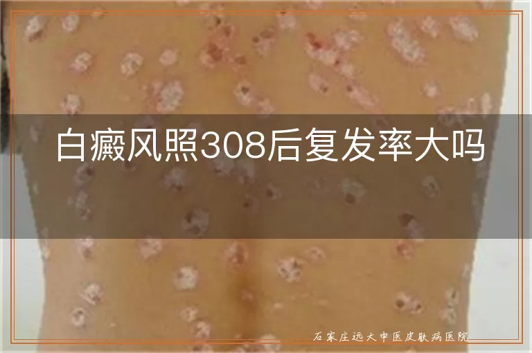 白癜风照308后复发率大吗