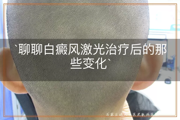 聊聊白癜风激光治疗后的那些变化