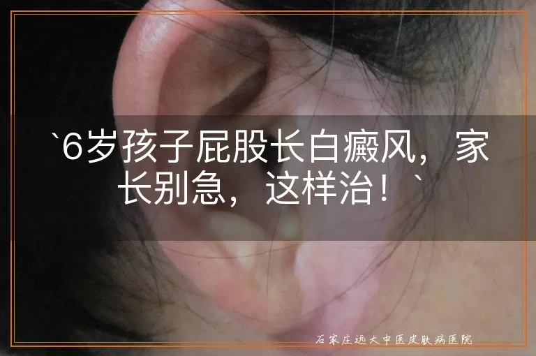 6岁孩子屁股长白癜风，家长别急，这样治！