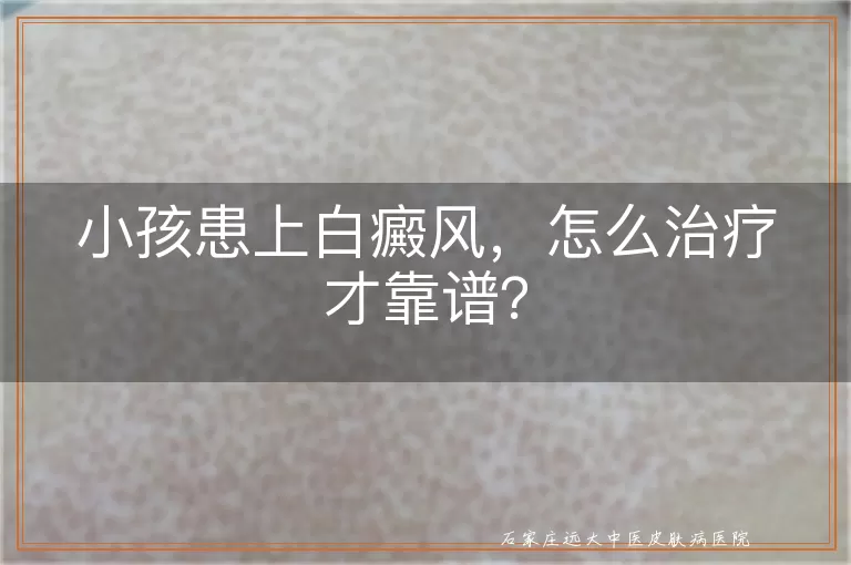 小孩患上白癜风，怎么治疗才靠谱？