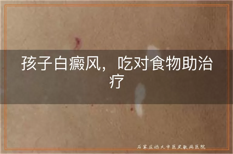孩子白癜风，吃对食物助治疗