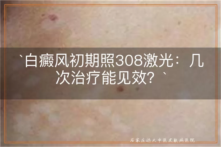 白癜风初期照308激光：几次治疗能见效？