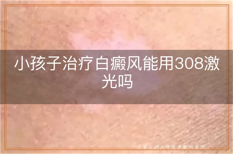 小孩子治疗白癜风能用308激光吗