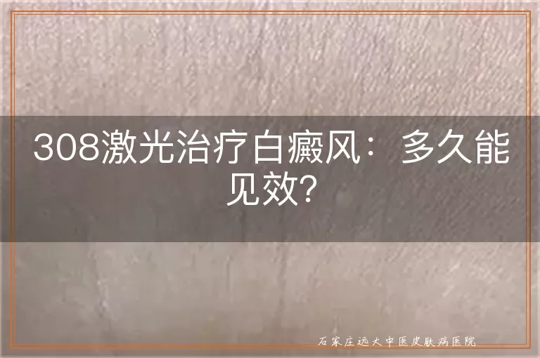 308激光治疗白癜风：多久能见效？