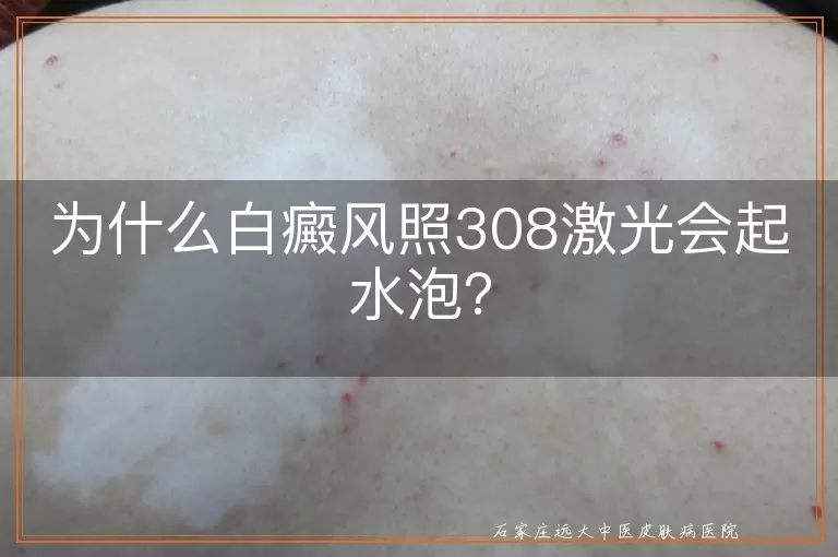 为什么白癜风照308激光会起水泡？