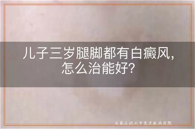 儿子三岁腿脚都有白癜风，怎么治能好？