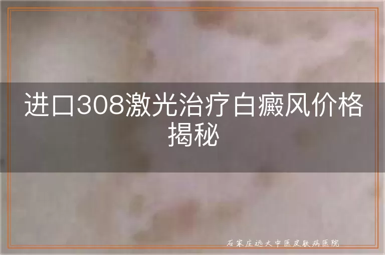 进口308激光治疗白癜风价格揭秘