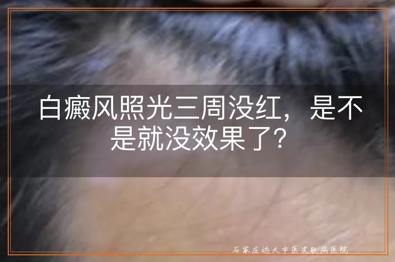 白癜风照光三周没红，是不是就没效果了？