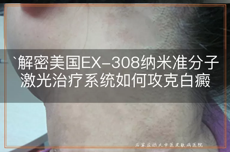 解密美国EX-308纳米准分子激光治疗系统如何攻克白癜风