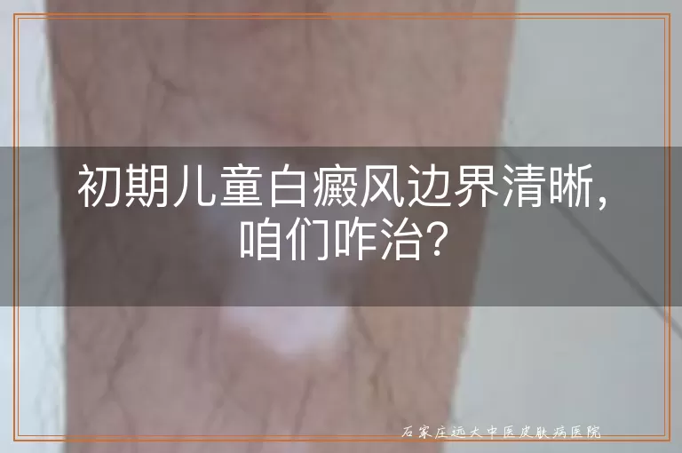 初期儿童白癜风边界清晰，咱们咋治？