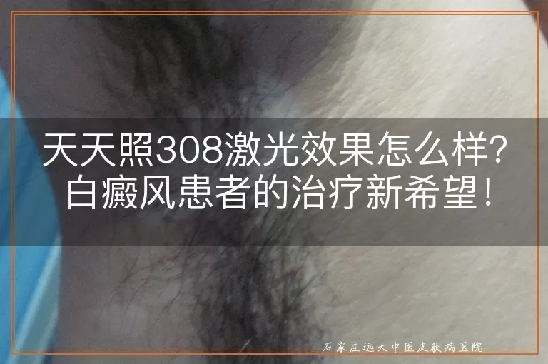 天天照308激光效果怎么样？白癜风患者的治疗新希望！