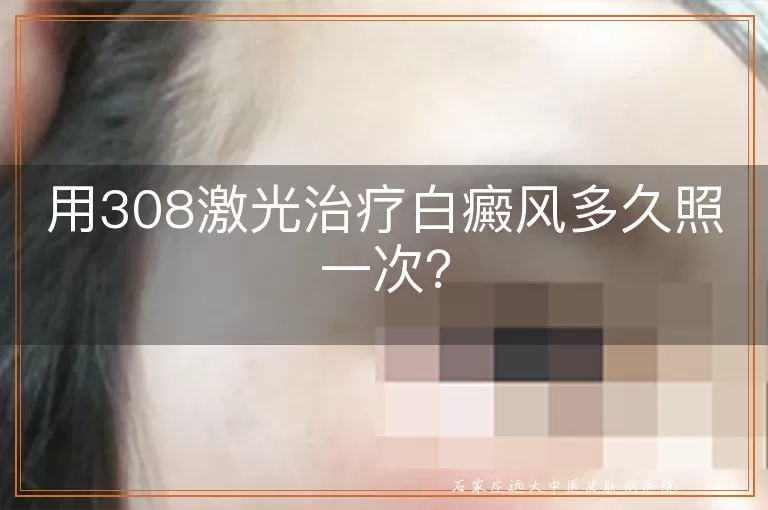 用308激光治疗白癜风多久照一次？