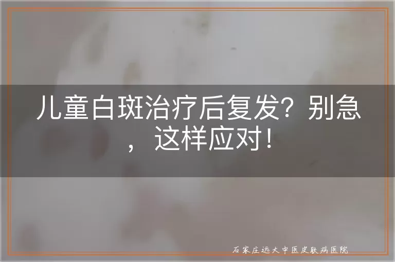 儿童白斑治疗后复发？别急，这样应对！