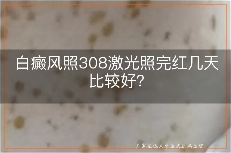 白癜风照308激光照完红几天比较好？