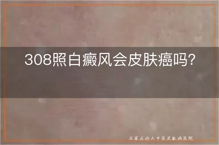 308照白癜风会皮肤癌吗？