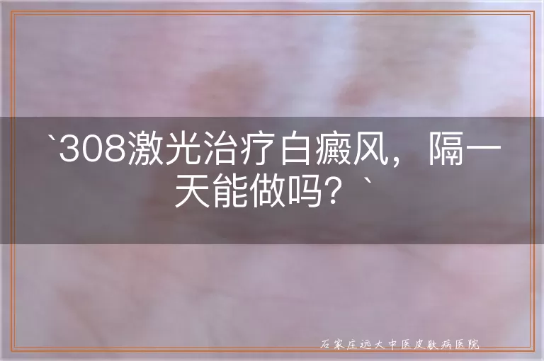 308激光治疗白癜风，隔一天能做吗？