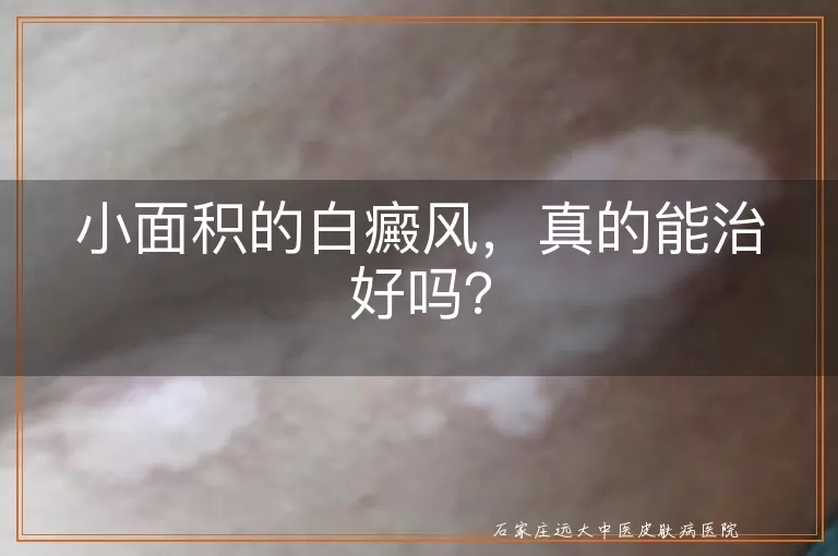 小面积的白癜风，真的能治好吗？