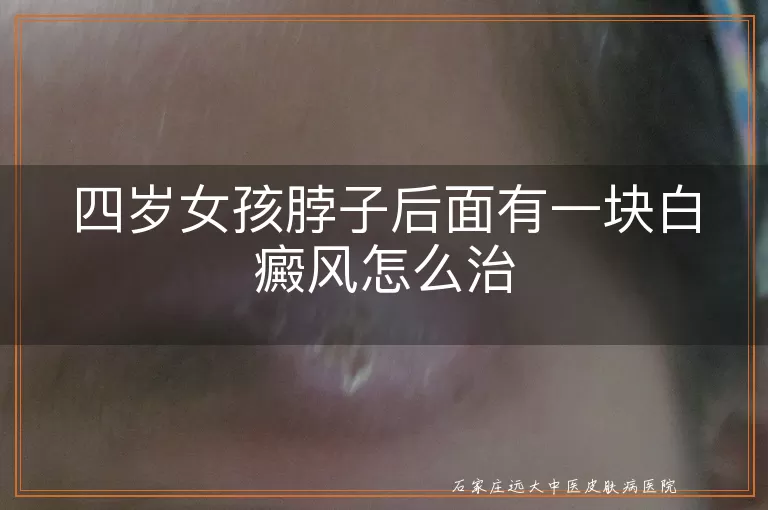 四岁女孩脖子后面有一块白癜风怎么治