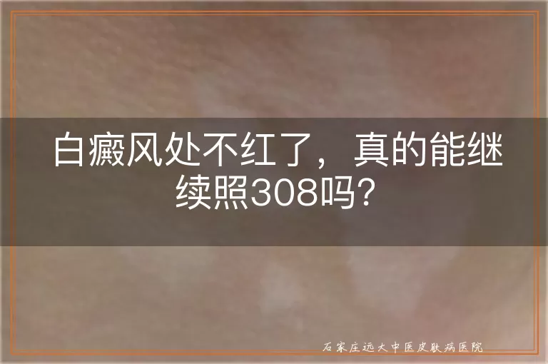 白癜风处不红了，真的能继续照308吗？