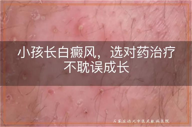 小孩长白癜风，选对药治疗不耽误成长