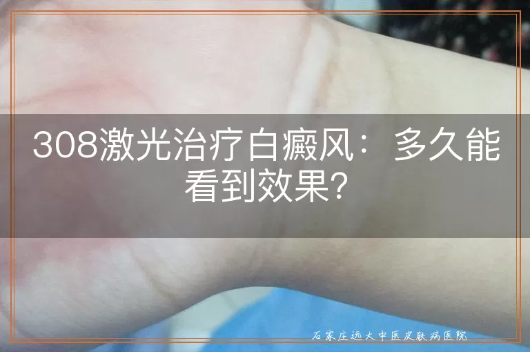 308激光治疗白癜风：多久能看到效果？