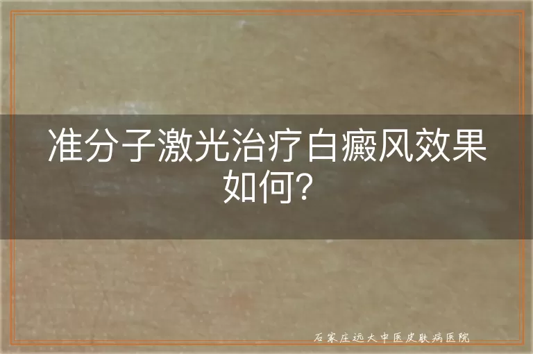 准分子激光治疗白癜风效果如何？