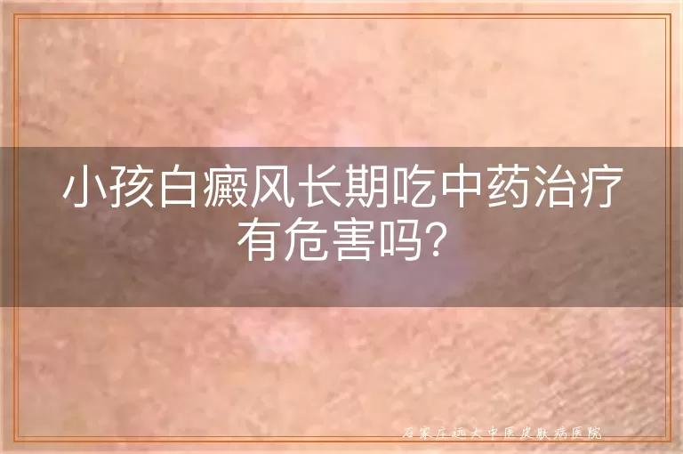 小孩白癜风长期吃中药治疗有危害吗？