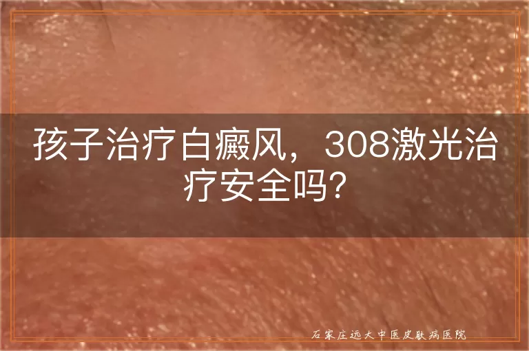 孩子治疗白癜风，308激光治疗安全吗？